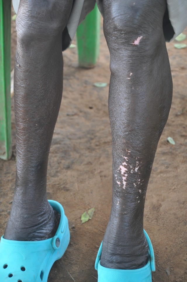 Leopard skin on man with Ochocerciasis